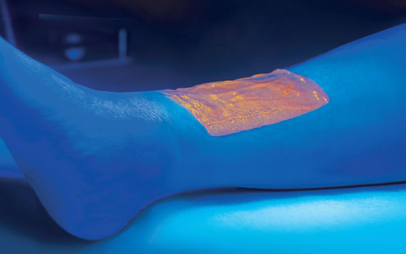 Publication in the peer-reviewed Journal of Wound Care – Evaluation of fluorescence biomodulation in the real-life management of chronic wounds: The EUREKA trial