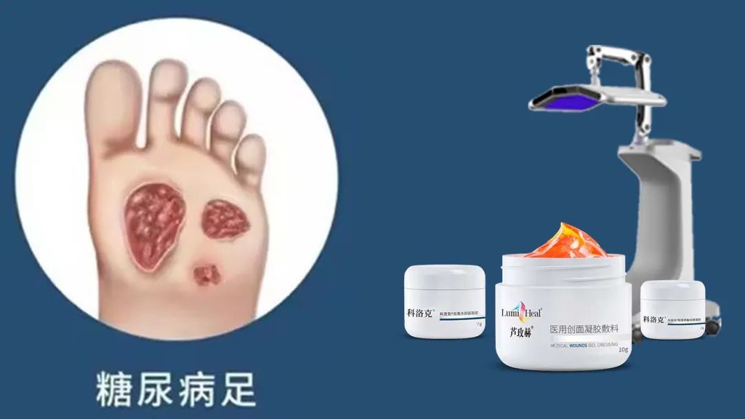 新品蘆玫赫：引領糖尿病足治療進入再生光技術新時代
